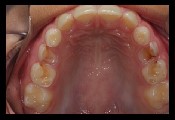 erosion molars