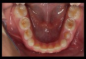 erosion molars