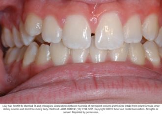 typical cases of mild fluorosis