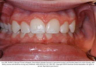 typical cases of mild fluorosis