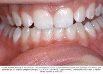 typical cases of mild fluorosis