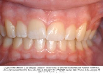 typical cases of mild fluorosis