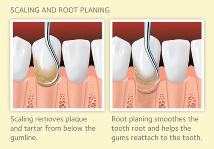 Scaling and Root Planing for Gum Disease MouthHealthy Oral Health Scaling and Root Planing for Gum Disease MouthHealthy Oral Health