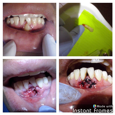 Picture of pulled tooth