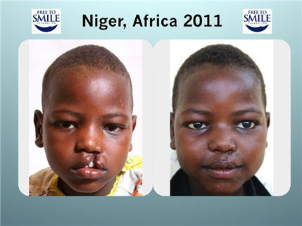 before/after photo fo cleft palate repair of boy in Niger, Africa