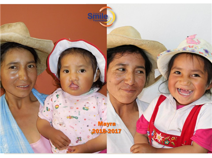 Before and After photo of child with cleft palate reconstruction