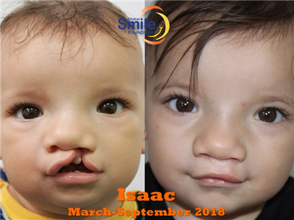 Before and After photo of boy with cleft palate reconstruction
