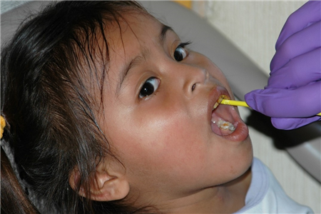 Child receiving Fluoride