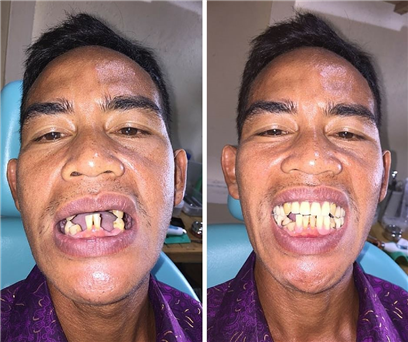 Before and after pictures of man with missing teeth