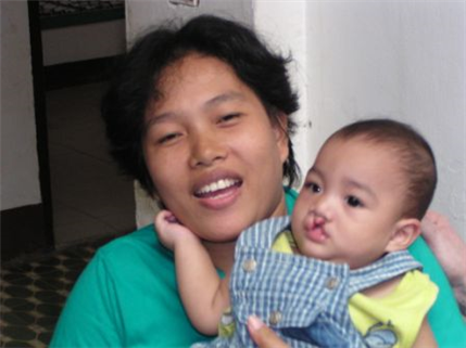 Mother and baby with cleft palate