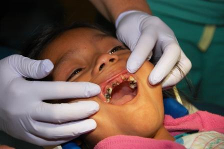 Child's mouth with caries