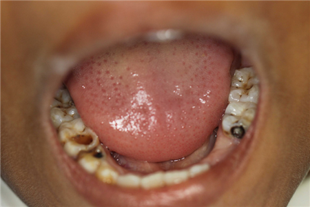 Close-up photo of small child's mouth and teeth with cavities and decay