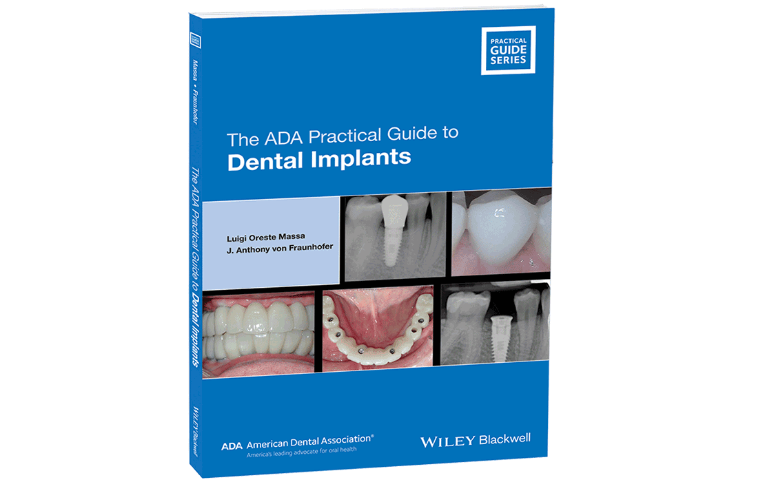 Get this Hands-on Guide to Provide Dental Implants